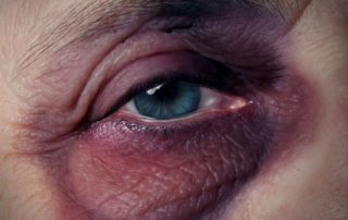 Elder Abuse