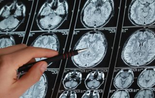 Alzheimer's vs Dementia