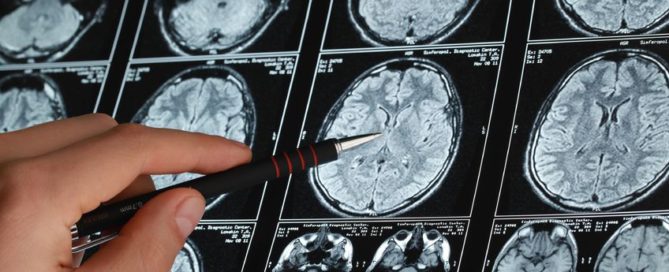 Alzheimer's vs Dementia